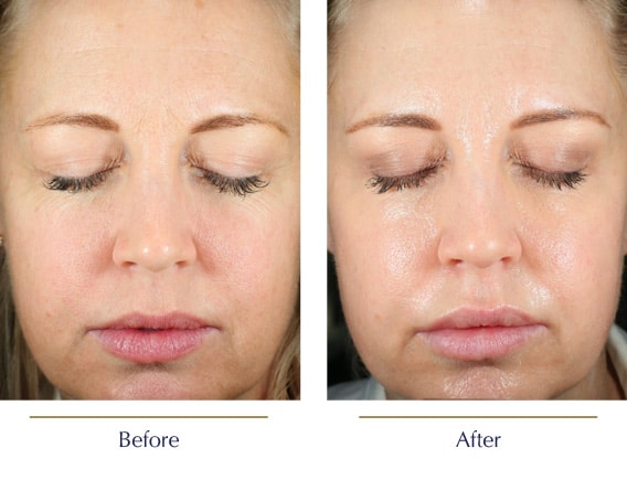 Before-and-after-CoolPeel3