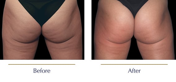 Before-and-after-Emtone-Cellulite