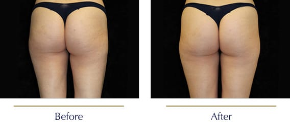 Before-and-after-Emtone-Cellulite3