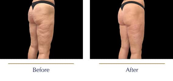 Before-and-after-Emtone-Cellulite4