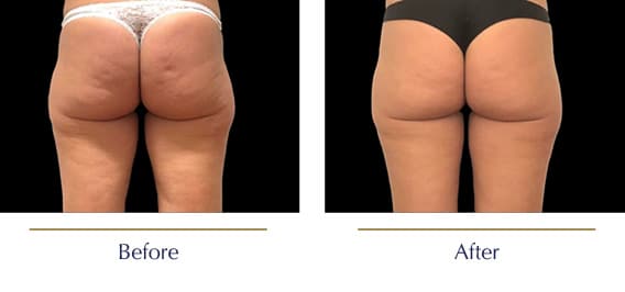 Before-and-after-Emtone-Cellulite7